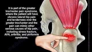 Gluteus Medius Tendon Tear  - Everything You Need To Know - Dr. Nabil Ebraheim