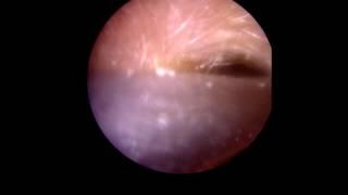 Ear Wax Removal