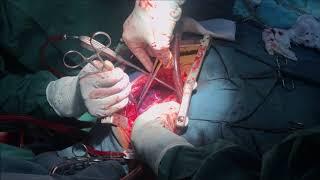 Surgical repair left ventricular aneurysm with coronary artery by pass grafting