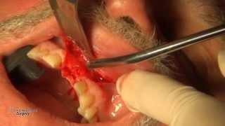 Dental Case 05 - Dr. Alexander V. Antipov