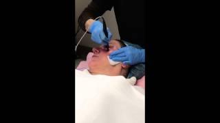 ThermiSmooth Treatment on Eyes