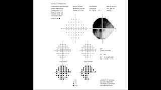 RS Visual Fields Part 2 Interpreting The Test Results