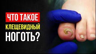 4 СОВЕТА КАК ИЗБАВИТЬСЯ ОТ КЛЕЩЕВИДНОГО НОГТЯ? ЧТО ЭТО ТАКОЕ? СОВЕТЫ И МНЕНИЕ ПОДОЛОГА