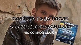 #КОЛЛИНЗГОВОРИТ — Minoxidil. Миноксидил для волос. Мой опыт использования и результат через 1,5 года