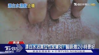 係金ㄟ! 漂白水治療異位性皮膚炎 醫師.病友說話了｜TVBS新聞 @TVBSNEWS01