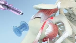 Right Shoulder Rotator Cuff Repair and Biceps Tenodesis Animation