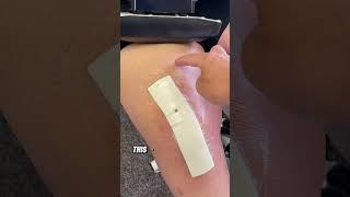 Day 2 of Physical Therapy After Total Knee Replacement - Dressing Assessment