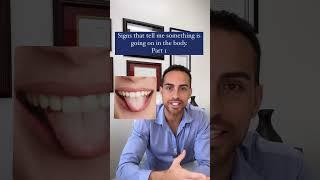 Do You Have A White Coat On Your Tongue? #candida #tongue #guthealth
