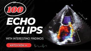 100 Echocardiography Clips with Interesting Findings