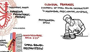 Superior mesenteric artery syndrome (SMA Syndrome) and Nutcracker Syndrome