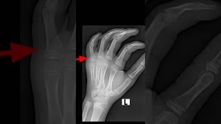 Little finger proximal phalanx fracture #xray