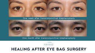 Healing After Eye Bag Removal Surgery, Reducing Downtime, and Avoiding Common Complications