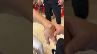 E2697 The lump on the⏱️lady's wrist was removed by the doctor in just a few seconds!