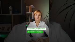 Как выглядит увеличение щитовидной железы #врач #здоровье #щитовиднаяжелеза #состояние