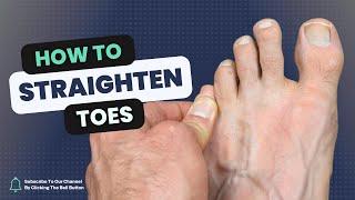 How to Straighten a Rotated Toe