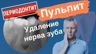 Пульпит. Удаление нерва зуба.