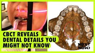 CBCT reveals dental details you might not know | NEXT NOW