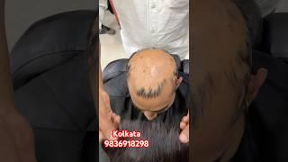 Men’s hair wig.natural hair wigs.Hair patch in Kolkata. Men’s hair patch centre in Kolkata#hairstyle