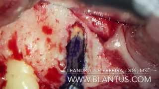 Endodontic Microsurgery