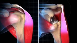 Biomechanical Summary of Reverse Shoulder Arthroplasty