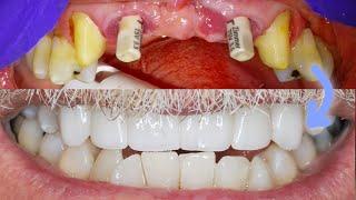 IMMEDIATE IMPLANT BRIDGE PROCEDURE On Front Teeth! Extraction, Bone Graft & Crown Placement Surgery