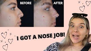 I FINALLY GOT A NOSE JOB!!! (kinda) Non-Surgical Nose Job