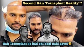 My Failed Hair Transplant Repaired - Contact Mohit Bhai for Guaranteed Result