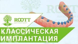 Имплантация на нижней челюсти.  Классическая имплантация зубов на нижней челюсти. ROOTT.