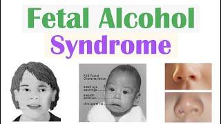 Fetal Alcohol Syndrome (FAS) | Risk Factors, Pathophysiology, Signs & Symptoms, Diagnosis, Treatment