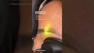 Pico laser tattoo removal on eyebrows