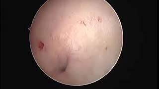 Hystroscopic view of displaced IUD with missed threads