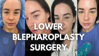 I FINALLY DID IT! GETTING A LOWER BLEPHAROPLASTY SURGERY IN NYC: cost, doctor, recovery process