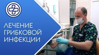 Подология - грибок ногтей? Подолог - миколог. МНПЦДК.