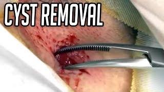 Messy Cyst Removal!  Just the Pop!  Dr. John Gilmore