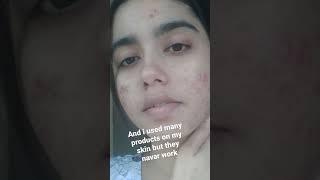 minimalist niacinamide zine serum for ance pro skin#shorts #shortsindia #youtubeshorts #skincare