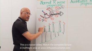 ECG - EKG Chest Leads Abnormalities of R wave progression 🫀