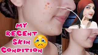 How I Get Rid of Pimples Overnight? Remove Acne & Pimples Permanently