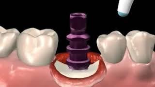 Complete Dental Implant Procedure