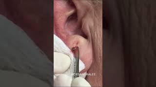 A Nice Earlobe Blackhead