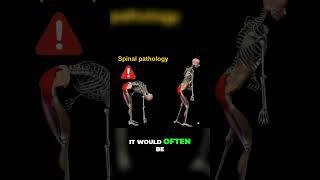 Bending forward creates pain? #mcgill #backpain #drstuart