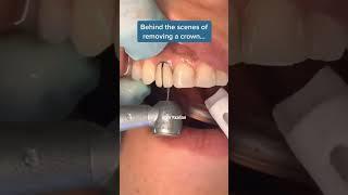 Removing a crown | front tooth crown | porcelain crown procedure | Dr. Yazdan  #cosmeticdentist