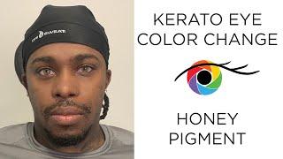 Eye Color Change from Dark to Light Brown with Kerato