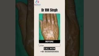 Vitiligo Treatment By Dr RM Singh Best Skin Doctor,Skin Specialist #vitiligotreatment