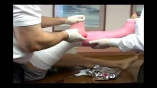 Application Long Leg Cast | Fiberglass Medical Leg Cast