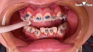 Braces On - Molar Bands - Tooth Time Family Dentistry