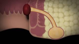 ANAL FISTULA TREATMENT - 3D ANIMATION