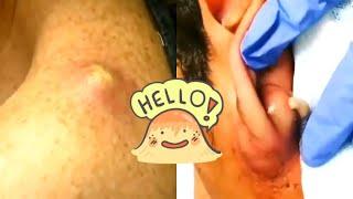 Super Big Pimples Popping! Bigger Pimples/ Pimple Popping Compilation/ ВЫДАВЛИВАНИЕ ОГРОМНЫЕ ПРЫЩИ