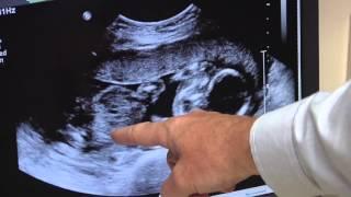 Gestational Diabetes | Pregnancy Care | Marian Regional Medical Center | HealthBreak