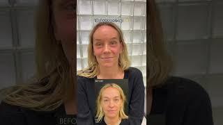 Eyelid Surgery & Brow Lift #upperblepharoplasty #eyelidlift #lowerblepharoplasty #browlift #nosejob