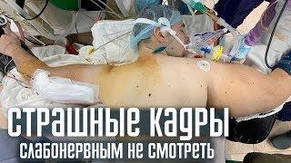 Страшные кадры удаления РУКИ-БАЗУКИ. Кирилл Терешин УДАЛИЛ РУКИ